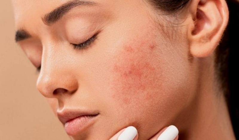 여드름 부위별 원인