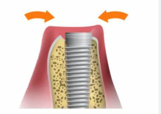 동탄-임플란트-잘하는-치과-동탄-임플란트-유명한-곳-동탄-임플란트-가격