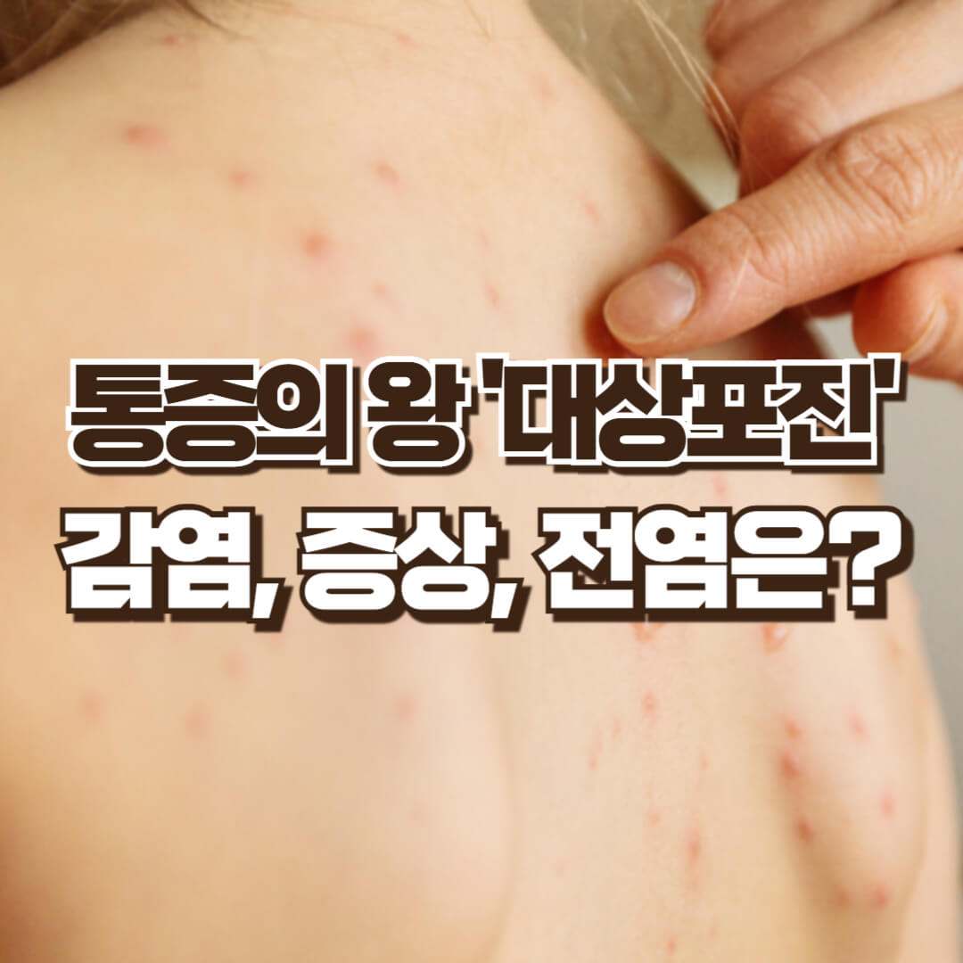 대상포진 증상 및 전염