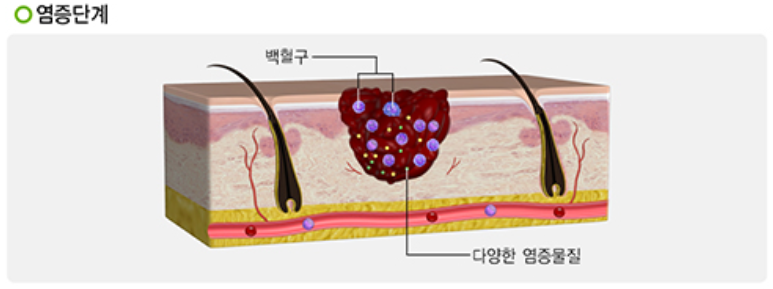 염증단계