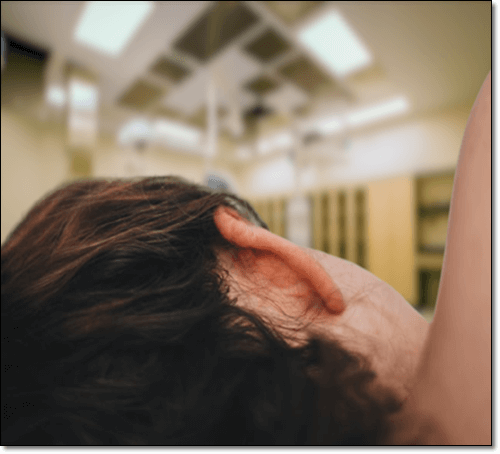 스파르가눔증 증상, 입원 환자