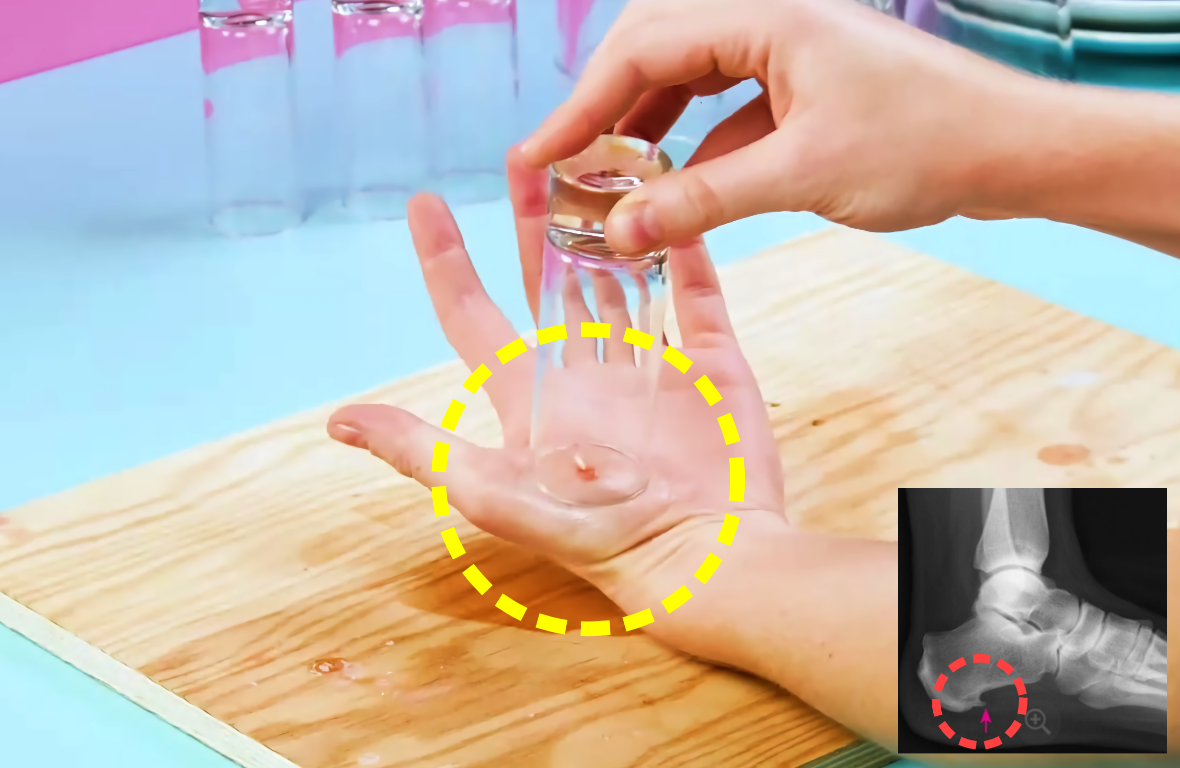 가시나 이물질이 박혔을때 응급조치 하는모습