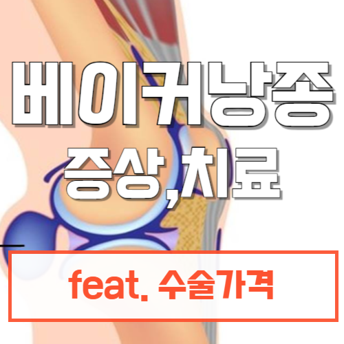 베이커낭종
