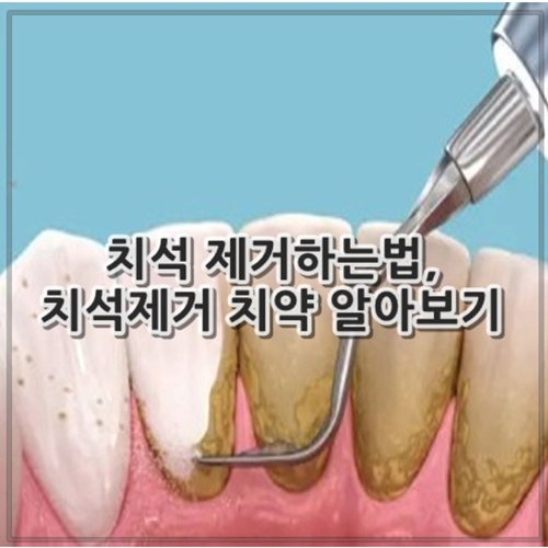 치석 제거하는법, 치석제거 치약 알아보기