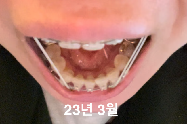 2년 7개월 교정 중 과개교합 돌출입 교정 일기