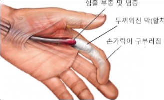 손이 붓는 이유-9