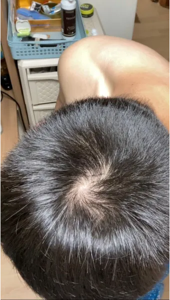 정수리가 아픈 이유와 완화하는 방법_13