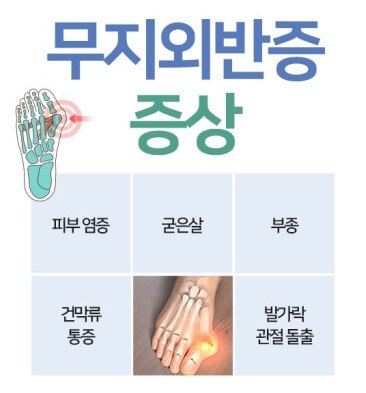 무지외반증의 증상
