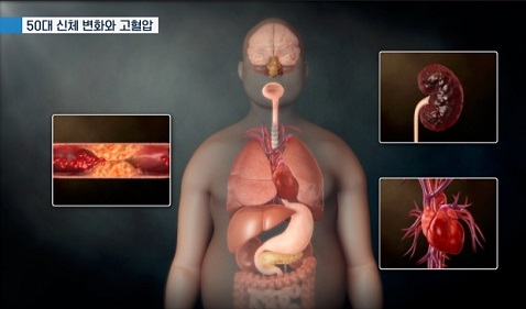 50대고혈압