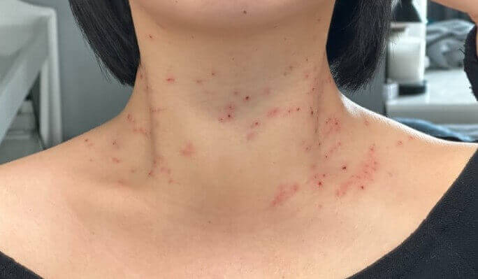 쥐젖 레이저 치료 전 상태