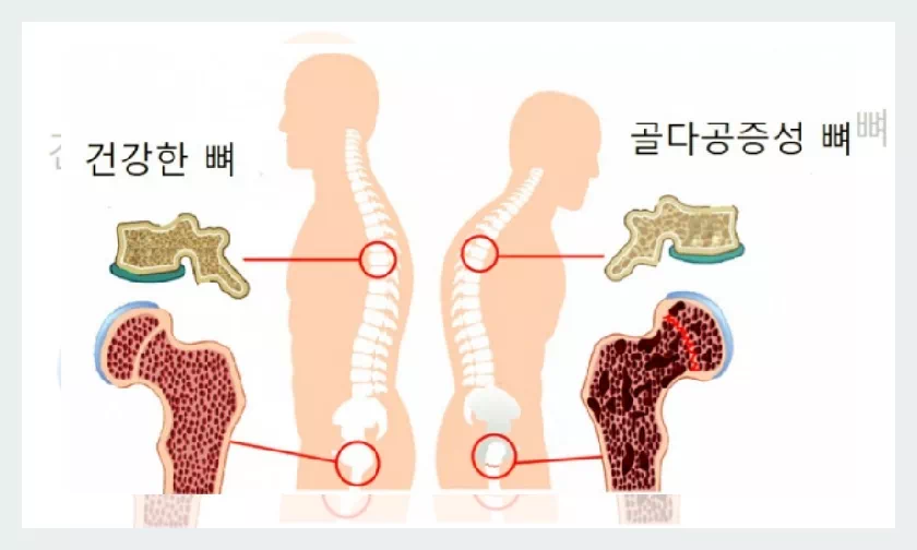 골다공증성 뼈 비교