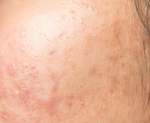 도미나크림 부작용