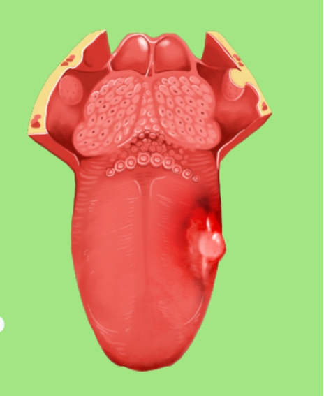 구강암 초기 모습