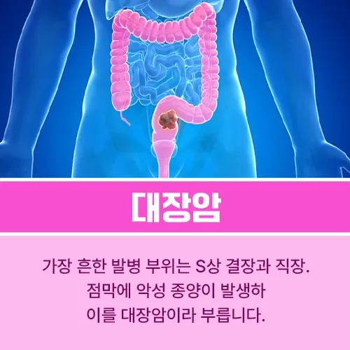 대장암 1기 증상