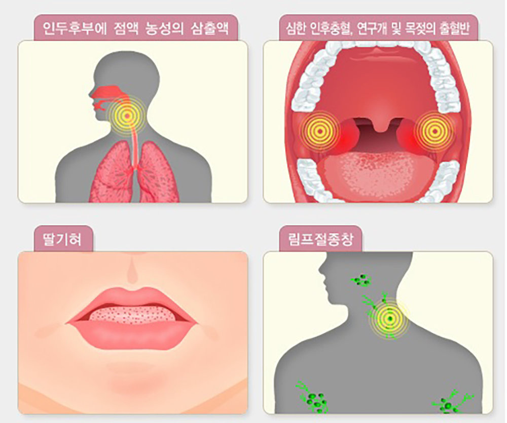 성홍열 증상