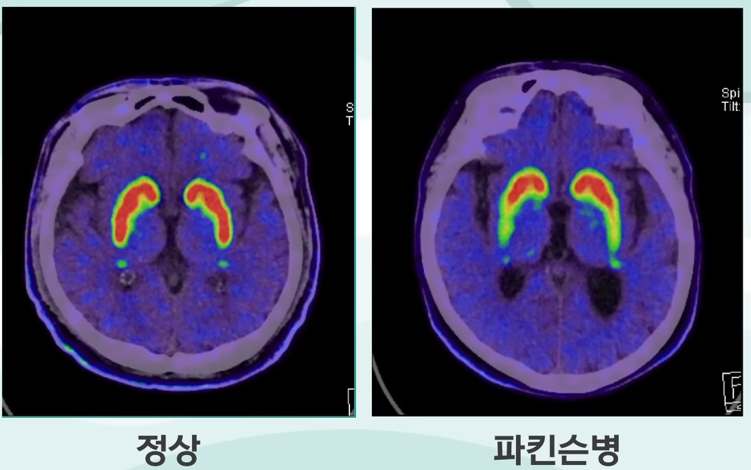 파킨슨과 알츠하이머