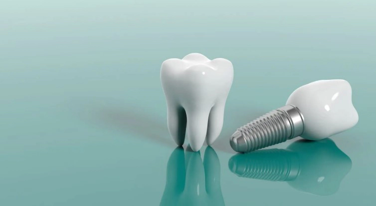 임플란트 종류