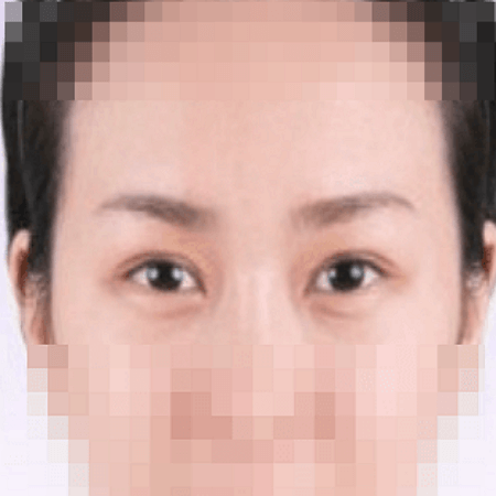 상안검 수술 후 여성의 모습