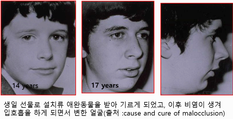 성장기 입호흡으로 인해 변형 성장한 얼굴