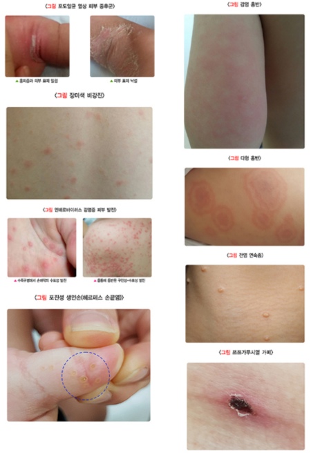 두드러기가 생겼다 사라지는 이유