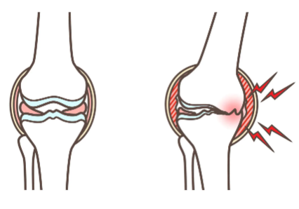 무릎이 아플 때의 원인