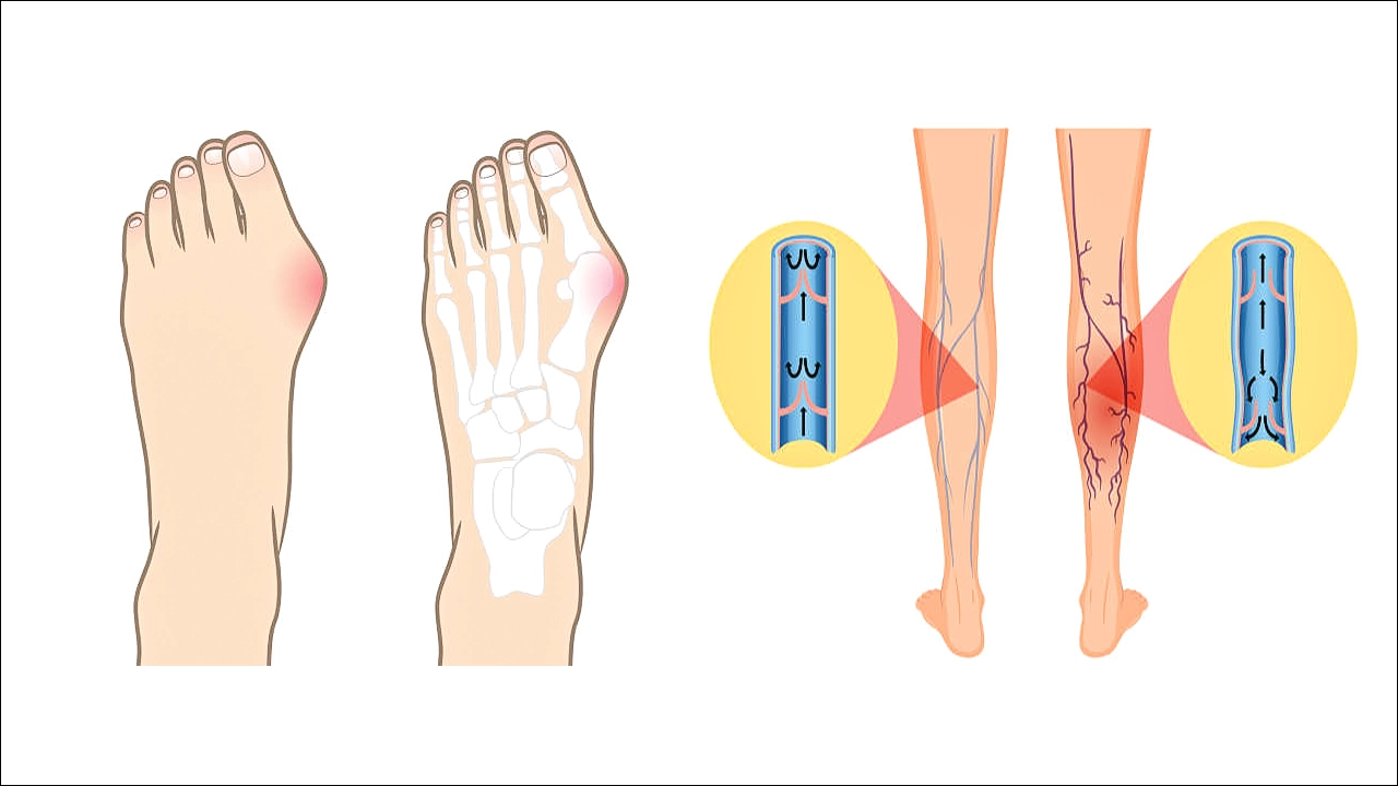 무지외반증과 하지정맥류 예방 발 건강 지키는 법