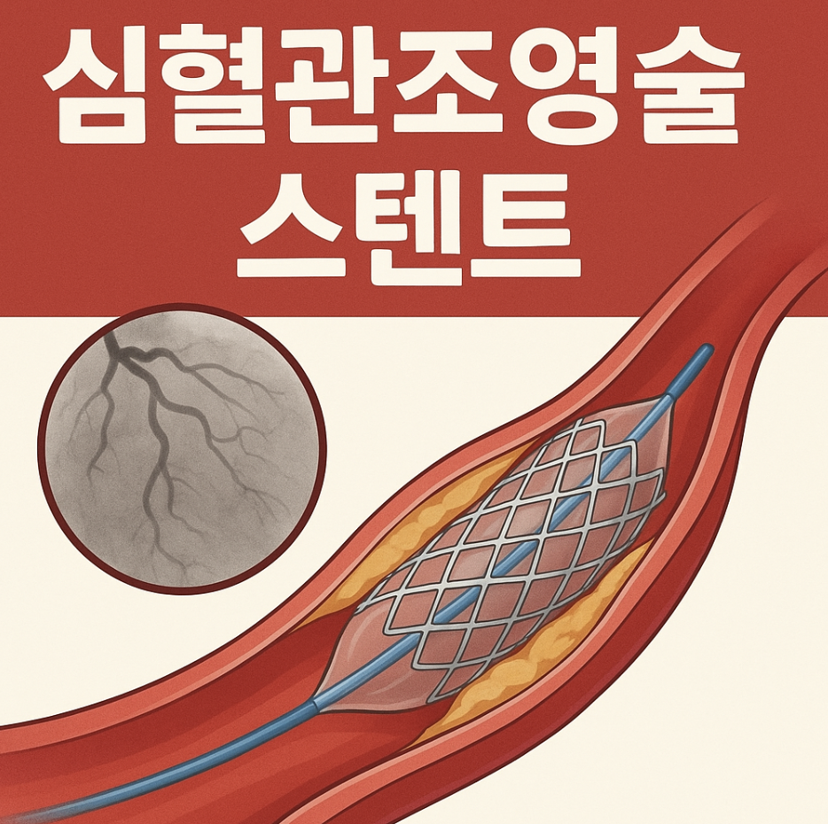 심혈관조영술 스텐트 시술 방법, 비용, 보험 여부 총정리