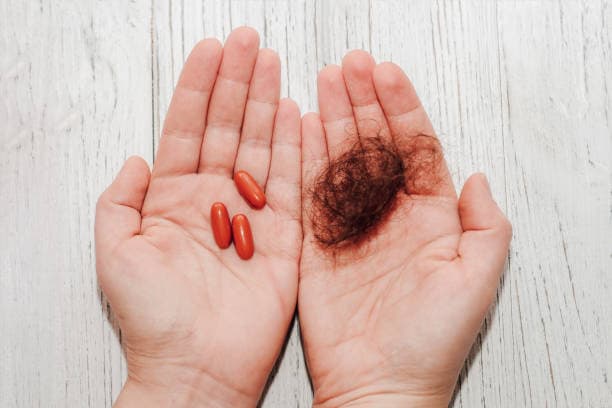 탈모약 결정 기준