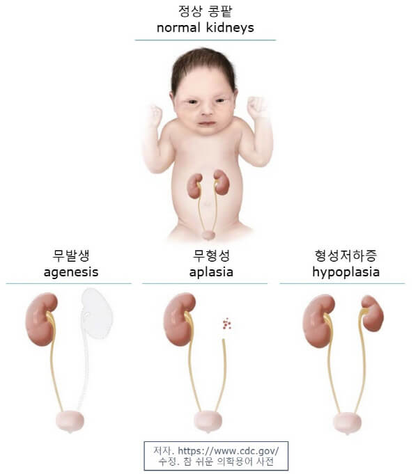 무발생 무형성 형성저하증의 차이