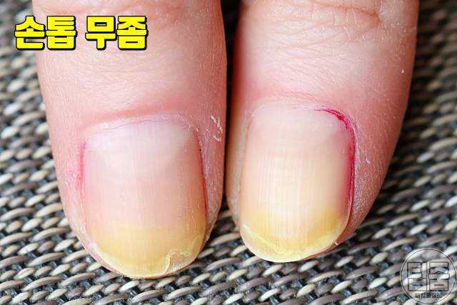 손톱 갈라짐 이유 손톱부러짐 손톱무좀