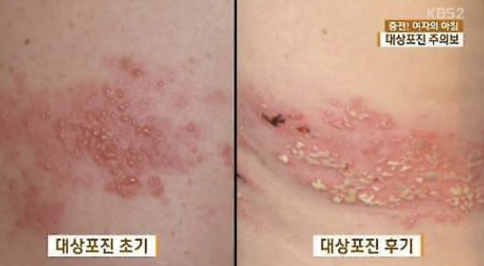 대상포진 초기증상 2
