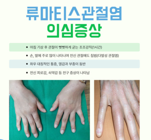 류마티스 관절염의 초기 증상 관련 이미지