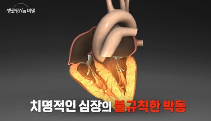 생로병사의비밀-부정맥-정보영-교수