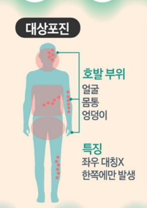대상포진 발병위치