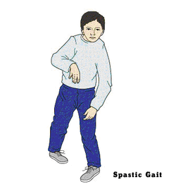 Spastic type