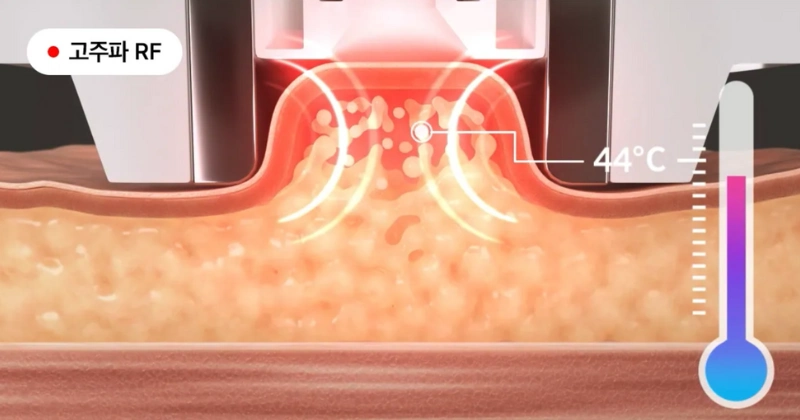 메디큐브 에이지알 바디샷
