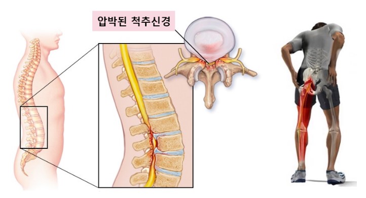퇴행성 협착증