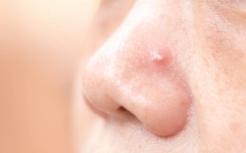 여드름 부위별 원인