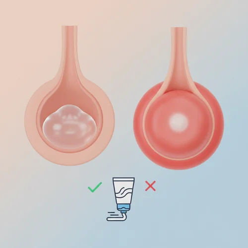 아젤리아크림, 좁쌀여드름에 왜 효과 없을까요?