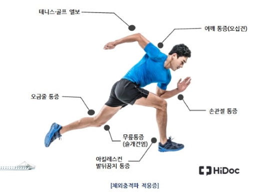 체외충격파 대상