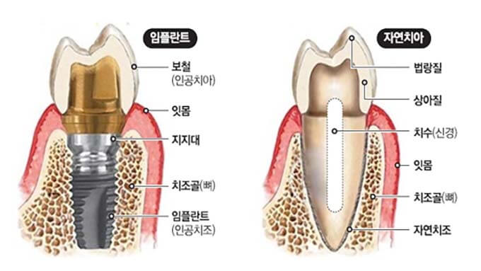 임플란트와 자연치아 비교