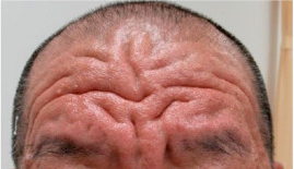 경피골막증 원인 분석 및 치료방법3