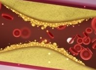 고지혈증에 좋은음식 및 고지혈증 증상
