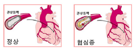 협심증 치료 방법
