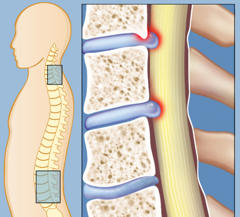 척추관협착증 수술비용 완전정복: 7가지 충격적 진실과 실제 환자 후기 분석