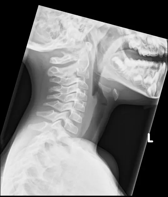 소아 정상 X-ray