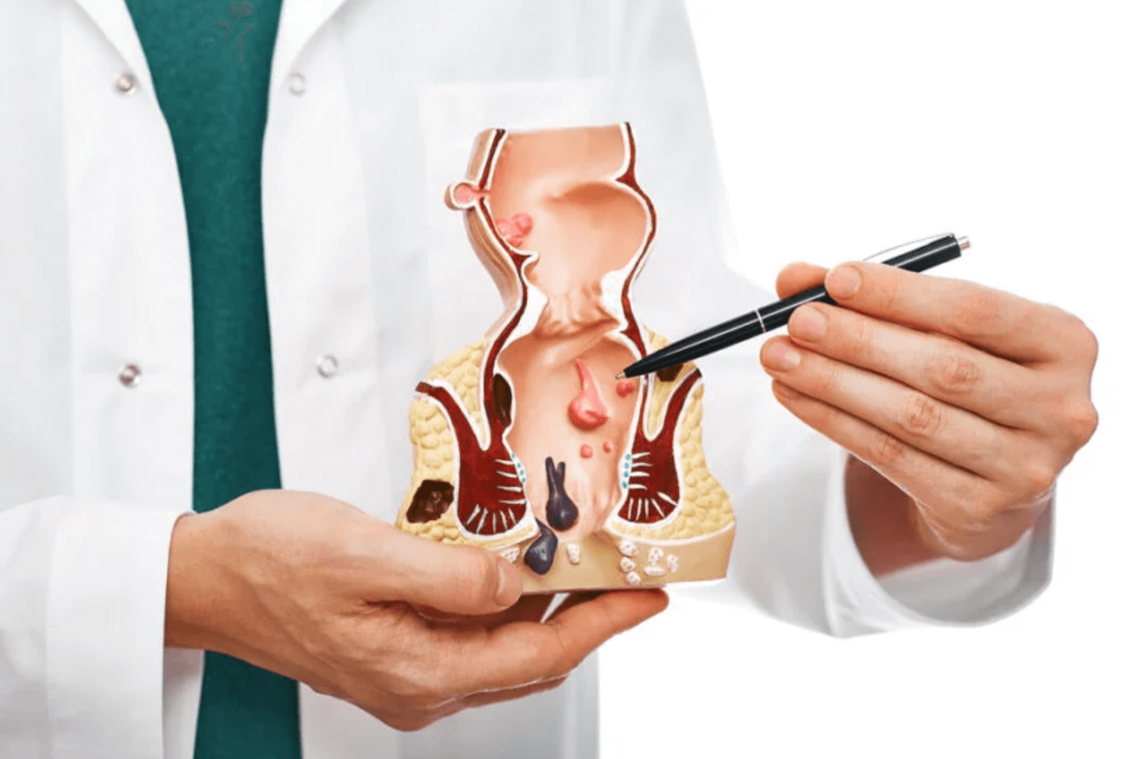 치질 수술 기간