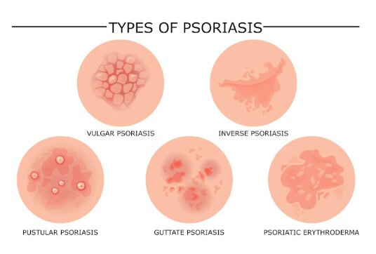 대상포진-전염-예방-수칙-전염성-5