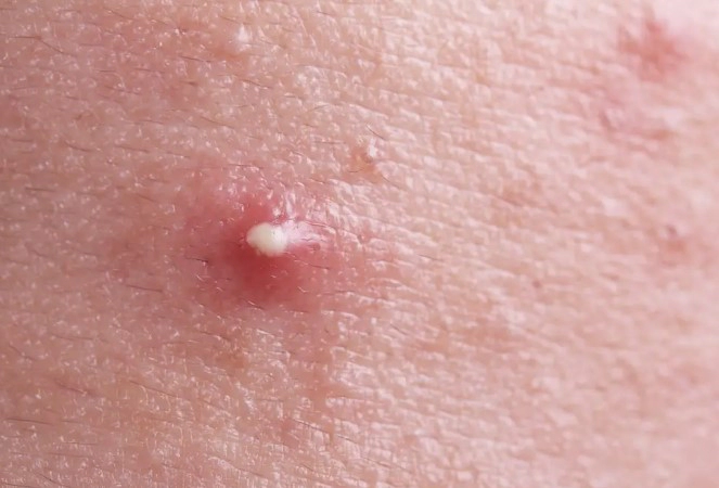 화농성 여드름 연고 3가지 추천