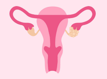 자궁근종 증상, 수술후 회복기간, 크기별 치료 총정리 (2024ver)